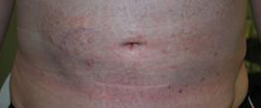 Male tummy, after Belly Button Surgery treatment, front view, patient 113