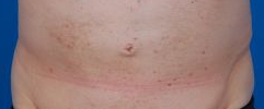 Male tummy, before Belly Button Surgery treatment, front view, patient 113
