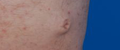 Male tummy, before Belly Button Surgery treatment, r-side oblique view, patient 113