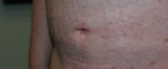 Male tummy, after Belly Button Surgery treatment, l-side oblique view, patient 113