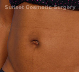 Woman's tummy, after Belly Button Surgery treatment, l-side oblique view, patient 2