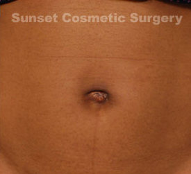Woman's tummy, after Belly Button Surgery treatment, front view, patient 2