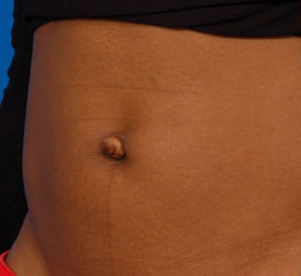 Woman's tummy, before Belly Button Surgery treatment, l-side oblique view, patient 2