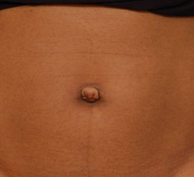Woman's tummy, before Belly Button Surgery treatment, front view, patient 2
