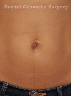 Woman's tummy, after Belly Button Surgery treatment, front view, patient 4