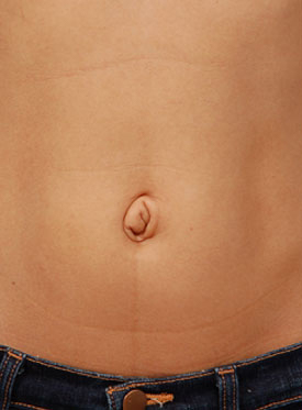 Woman's tummy, before Belly Button Surgery treatment, front view, patient 4