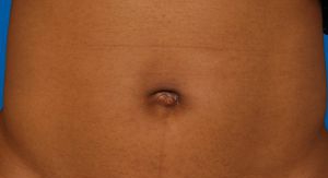 Woman's tummy, after Belly Button Surgery treatment, front view, patient 5
