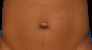 Woman's tummy, before Belly Button Surgery treatment, front view, patient 5