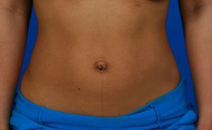 Woman's tummy, before Belly Button Surgery treatment, front view, patient 6