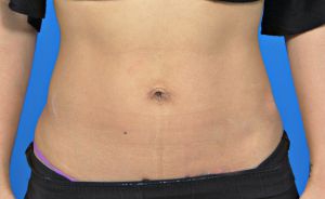 Woman's tummy, after Belly Button Surgery treatment, front view, patient 6