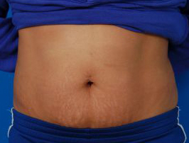 Woman's tummy, after Belly Button Surgery treatment, front view, patient 7