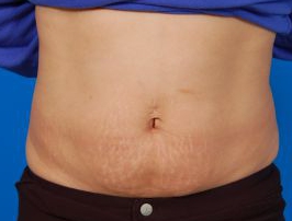 Woman's tummy, before Belly Button Surgery treatment, front view, patient 7