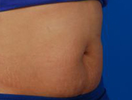 Woman's tummy, after Belly Button Surgery treatment, r-side oblique view, patient 7