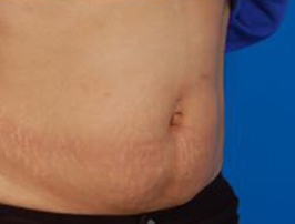 Woman's tummy, before Belly Button Surgery treatment, r-side oblique view, patient 7
