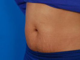 Woman's tummy, after Belly Button Surgery treatment, l-side oblique view, patient 7