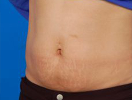 Woman's tummy, before Belly Button Surgery treatment, l-side oblique view, patient 7