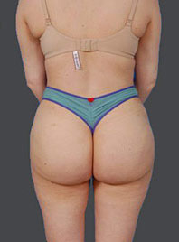 Woman's body, after Reversal Brazilian Butt Lift treatment, b-side view, patient 13