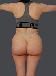 Woman's body, before Reversal Brazilian Butt Lift treatment, b-side view, patient 13