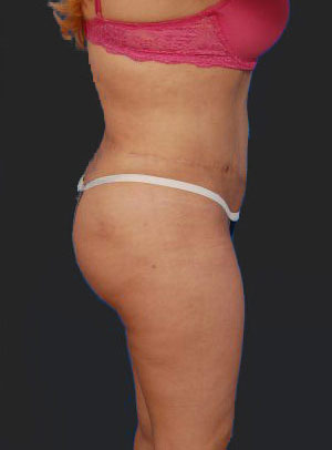 Woman's body, after Brazilian Butt Lift treatment, l-side view, patient 8