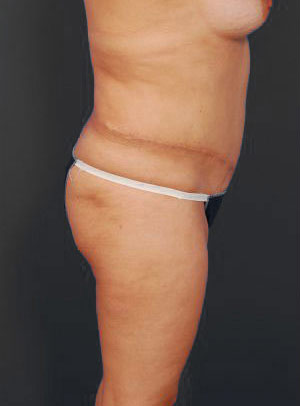 Woman's body, before Brazilian Butt Lift treatment, l-side view, patient 8