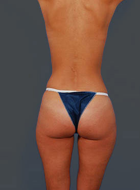 Woman's body, before Brazilian Butt Lift treatment, b-side view, patient 9