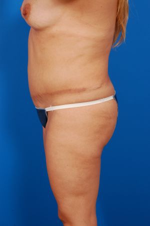 Woman's body, before Brazilian Butt Lift treatment, r-side view, patient 8