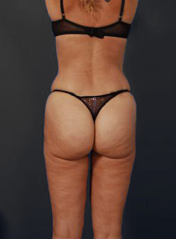 Woman's body, after Brazilian Butt Lift treatment, b-side view, patient 12