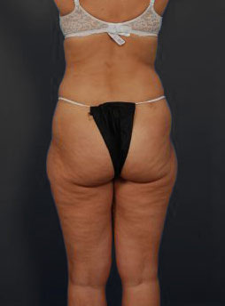 Woman's body, before Brazilian Butt Lift treatment, b-side view, patient 12