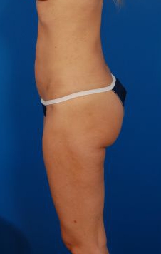 Woman's body, after Brazilian Butt Lift treatment, l-side view, patient 10