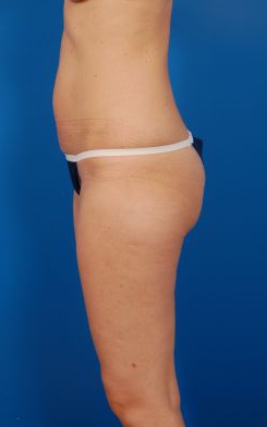 Woman's body, before Brazilian Butt Lift treatment, l-side view, patient 10