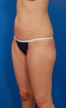 Woman's body, before Brazilian Butt Lift treatment, l-side oblique view, patient 10