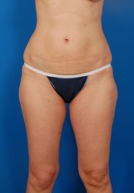 Woman's body, before Brazilian Butt Lift treatment, front view, patient 10