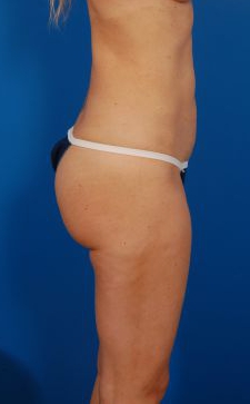 Woman's body, after Brazilian Butt Lift treatment, r-side view, patient 10