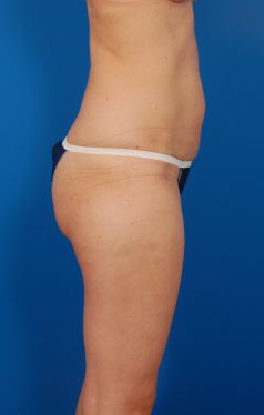 Woman's body, before Brazilian Butt Lift treatment, r-side view, patient 10