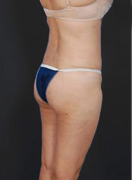 Woman's body, after Brazilian Butt Lift treatment, r-side back view, patient 2