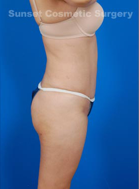 Woman's body, after Brazilian Butt Lift treatment, r-side view, patient 2