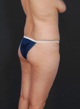 Woman's body, before Brazilian Butt Lift treatment, r-side back view, patient 2
