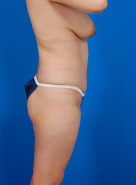 Woman's body, before Brazilian Butt Lift treatment, r-side view, patient 2