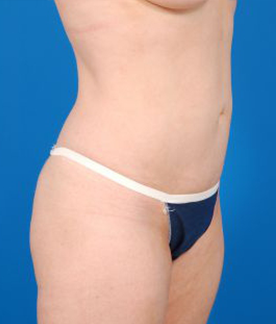 Woman's body, after Brazilian Butt Lift treatment, r-side oblique view, patient 3