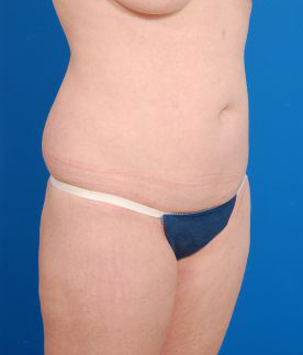 Woman's body, before Brazilian Butt Lift treatment, r-side oblique view, patient 3