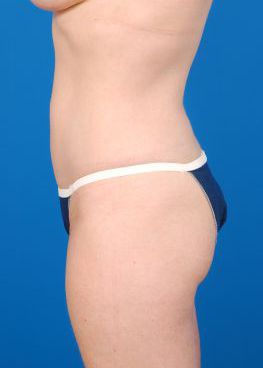 Woman's body, after Brazilian Butt Lift treatment, l-side view, patient 3