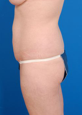 Woman's body, before Brazilian Butt Lift treatment, l-side view, patient 3
