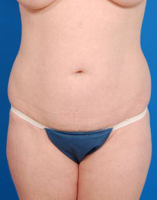 Woman's body, before Brazilian Butt Lift treatment, front view, patient 3