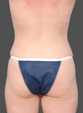 Woman's body, after Brazilian Butt Lift treatment, b-side view, patient 3