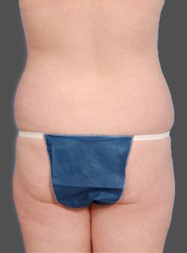 Woman's body, before Brazilian Butt Lift treatment, b-side view, patient 3