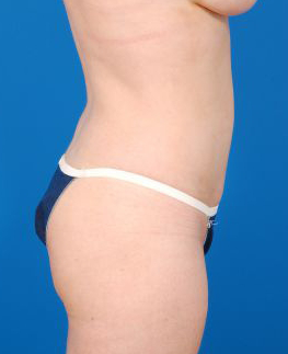 Woman's body, after Brazilian Butt Lift treatment, r-side view, patient 3