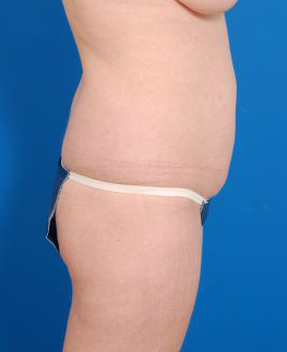 Woman's body, before Brazilian Butt Lift treatment, r-side view, patient 3