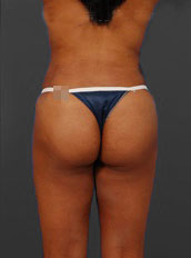 Woman's body, after Brazilian Butt Lift treatment, b-side view, patient 4