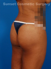 Woman's body, after Brazilian Butt Lift treatment, r-side back view, patient 4
