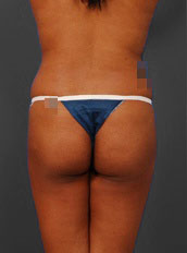 Woman's body, before Brazilian Butt Lift treatment, b-side view, patient 4
